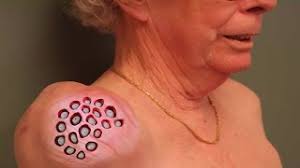 In 2018 she set guinness world record in the same category at 170.5 cm. Biggest Ingrown Hair In The World