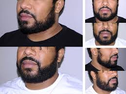 Beard Transplant NYC