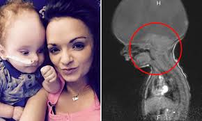 Baby born without a brain celebrates his 2nd birthday and says 'Mummy' for  first time