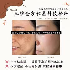 健康祛斑效果脸😍 斑斑点点混合斑...