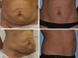 Tummy tuck scars over time. Mini Tummy Tuck London Mini Abdominoplasty Uk Mini Tummy Tuck Cost