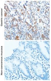 Precancerous cells are present, but they only affect a small area and are slow growing. New Genetic Cause Of Gastric And Prostate Cancer Identified Eurekalert Science News