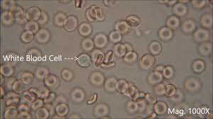 Images related to blood cancer. Red Blood Cells Under The Microscope Hypo And Hypertonic Solutions Youtube