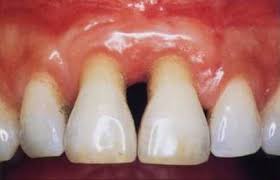 Tạo vạt lợi phía hàm ếch (phía vòm miệng)