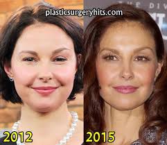 Especially since she now has reached her late forties age and will be … Ashley Judd Plastic Surgery Plastic Surgery Hits