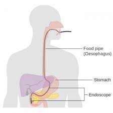 Is the most common type, accounting for more than 90% of pancreatic cancers. Pancreatic Cancer Cancerquest