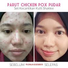 Dr ramesh bansal skin care tips. Emalin Beauty Chicken Pox Kalau Kena Masa Dewasa Lagi Facebook