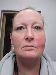 Did anyone get poison oak at Point Lobos?