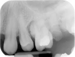 Image result for Periodontal Abscess