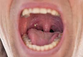 Black And White Spots On Tonsils Pin On General