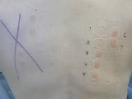 Image result for Patch Testing