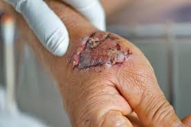 You have aches and pains or a fever. 3 Severe Types Of Infections From Dog Bites