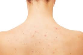 Alat ini bisa di atur keluar bijinya. Ini Dia Penyebab Penyebab Jerawat Pada Badan Yang Harus Diketahui Orami