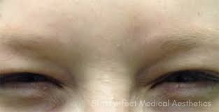 Ceo at skin perfect medical aesthetics. Before And After Photos Brea Plastic Surgery Gallery Costa Mesa Skin Perfect Medical