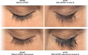 It is important to apply latisse® only to the skin of the upper eyelid margin at the base Latisse Aveda Spa And Massage Johnson City Tn Body Health Mind Center