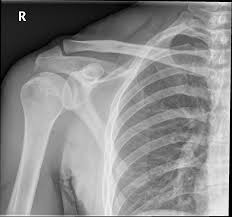 Urgent care is appropriate when your regular doctor's office is closed, such as on weekends or holidays. Emrad Radiologic Approach To The Traumatic Shoulder