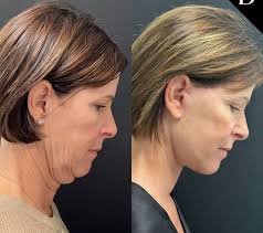 Deep Plane Facelift in Tampa, FL | Dr. Demetri MD