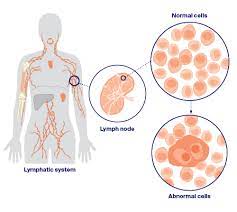 Hodgkin Lymphoma Cancer Council Nsw