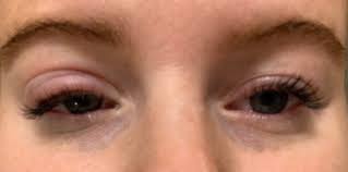 The feeling can also extend to your entire eye or eyelid. Any Allergic Reaction Tips I Love The Extensions Been Getting Them For 6 Months But The Past 3ish Visits I Ve Had A Reaction Swollen Itchy Raw On Both Eyes But Worse On