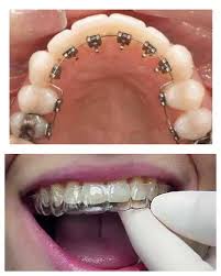 How Much More Expensive Is Lingual Braces Compared To Invisalign Lingual Braces Invisalign Orthodontics Braces