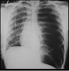 Image result for Open Pneumothorax