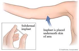 Have You Explored Different Options Birth Control Implant Birth Control Birth Control Methods