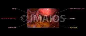 The medial umbilical ligaments are particularly easy to see in laparoscopy and represent an important anatomic landmark for. Surgical Anatomy Of The Female Pelvis By Laparoscopy