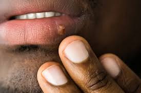 Image result for oral herpes symptoms roof of the mouth