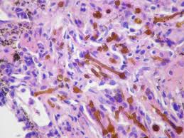 Mesothelioma histology includes the study of cancerous mesothelioma cells. Pneumoconiosis And Mesothelioma Flashcards Memorang