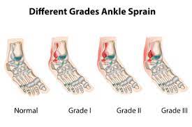 A grade 3 tear causes a significant amount of pain, swelling, and coloring of the lateral side of your ankle. The 3 Grades Of An Ankle Sprain How Chiropractic Can Help