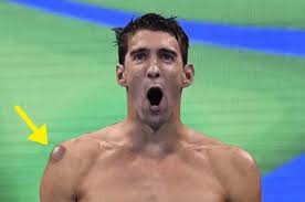 Olympic athletes are susceptible to unproven alternative practices such as chiropractic spinal manipulation, nasal strips, and hologram bracelets among others. For Everyone Wondering Wtf Cupping Is During The Olympics