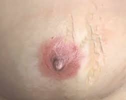Possible causes of penile mondor's disease 7. Mondor S Disease Causes Symptoms Diagnosis Treatment Prognosis