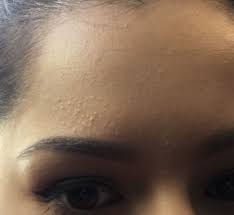 How I Helped Clear Forehead Bumps Subclinical Acne In 2020 Forehead Bumps Skin Bumps On Face Subclinical Acne