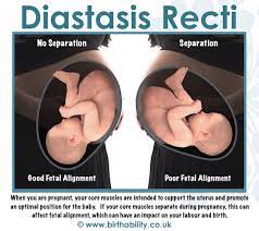 What are the consequences of diastasis recti? Diastasis Recti What Does It Mean For Pregnant And Postnatal Women Birthability