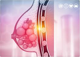 Inflammatory breast cancer causes the breast to appear swollen and inflamed. Discovering A Protein That Could Cause Breast Cancer To Spread