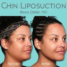 Natural-looking results! Getting rid of stubborn fat in the chin/neck can  make your jawline more contoured and beautiful. , Do you think you’re a  candidate for Chin Liposuction? , ⬇️ 𝐅𝐨𝐫 𝐂𝐨𝐧𝐬𝐮𝐥𝐭𝐚𝐭𝐢𝐨𝐧𝐬 ...