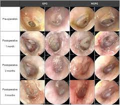 Effect Of Middle Ear Gelfoam On Hearing And Healing Process After Tympanoplasty A Prospective Randomized Case Control Study Sciencedirect