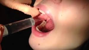 Underneath the gingiva, however, it may be around a few months before the socket starts to close. After Wisdom Tooth Removal Sycamore Il