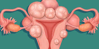 Because of that, many cases of this cancer are detected at. Women Are Now Posting Photos Of Their Uterine Fibroids All Over Reddit Women S Health
