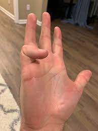 'the fifth digit and smallest of the fingers is the digitus minimus manus. To The Guy With The Extra Pinky Joint Can I Have One I Am Missing A Joint In Each Pinky Mildlyinteresting