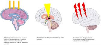 Image result for Thalamotomy