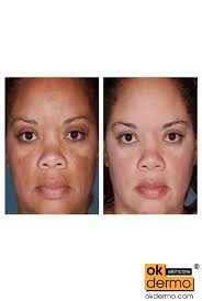 Buy Pure Hydroquinone 4% Cream for Skin Whitening Online