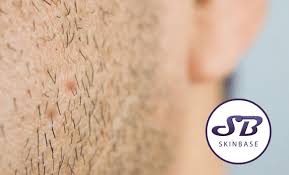 List of best ingrown hair treatment reviews in 2020. What Causes Ingrown Hairs And How To Treat Them Skinbase Facial