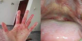 Hfmd biasanya terjadi pada musim panas dan awal musim gugur. Virus Hfmd Turut Jangkiti Orang Dewasa 10 Rawatan Ini Boleh Bantu Theasianparent Malaysia
