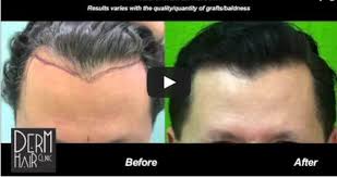 Explains the medication cimetidine (tagamet), a drug used in promoting the healing of active stomach and duodenal ulcers, and in reducing ulcer pain. Oral Minoxidil As A Hair Loss Drug