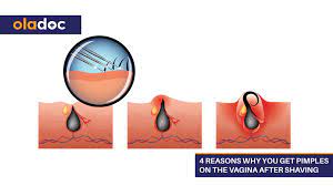 If your ingrown hair is on your bikini line or somewhere on your legs, it's also best to avoid any tight pants or hosiery. 4 Reasons Why You Get Pimples On The Vagina After Shaving Beauty And Skin Care Women S Health Oladoc Com