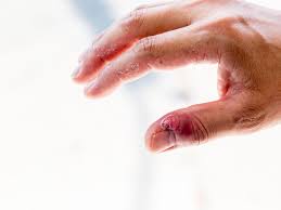 Your peeling skin on fingers could be caused by a condition called keratosis that affects more than 40% of americans. Skin Infection Around Fingernails And Toenails
