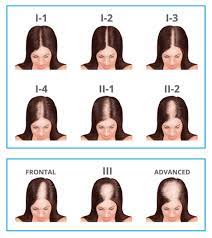 This article attempts to discuss several causes of hair thinning in women, preventive measures, and the recommended treatments available. Female Thinning Hair Hair Loss Pattern Baldness In Women