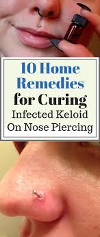 Nose Piercing Keloid Causes 10 Natural Home Remedies To Help Treat Keloid Keloidcsection Keloid Home Remedies Nose Piercing