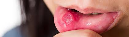 Image result for Oral thrush roof of mouth
